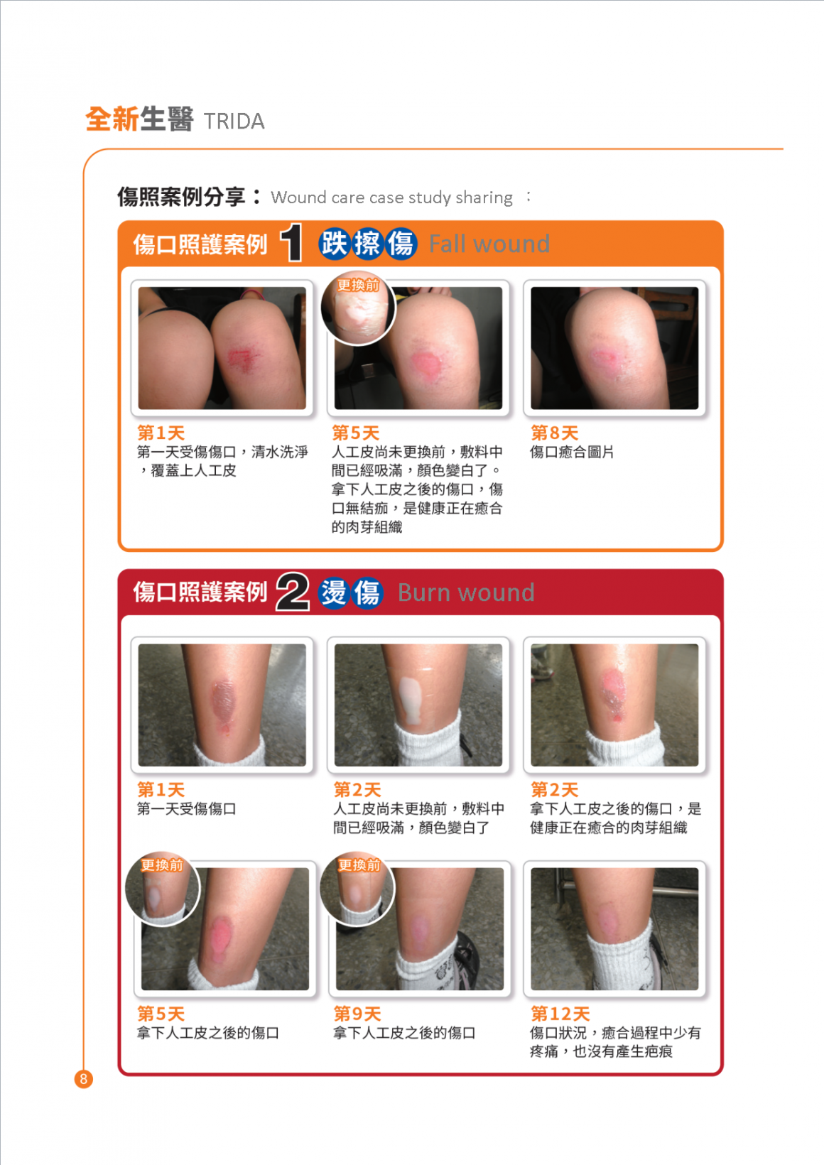 IGIBAN_Best Hydrocolloid Bandages for Minor Cuts and Burns - A Complete Guide - 1