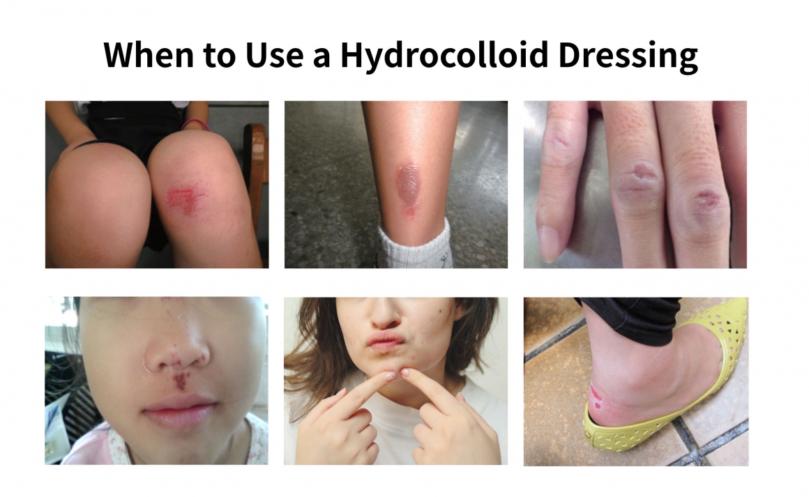 When to Use a Hydrocolloid Dressing TRIDA IGIBAN